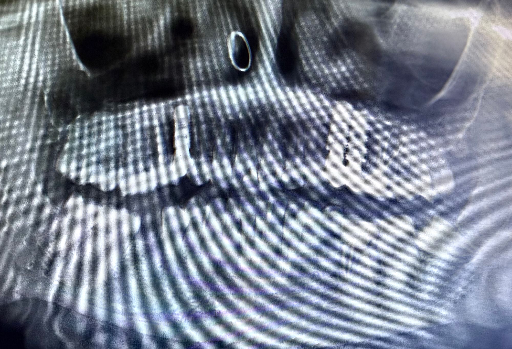 Bir hastanın üst çenesine yerleştirilmiş diş implantlarını gösteren panoramik röntgen