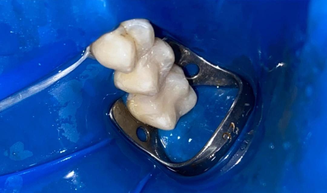 Aynı üst azı dişleri tedavi sonrasında, rubber dam altında polisajlı kompozit dolgularla yeniden şekillendirilmiş