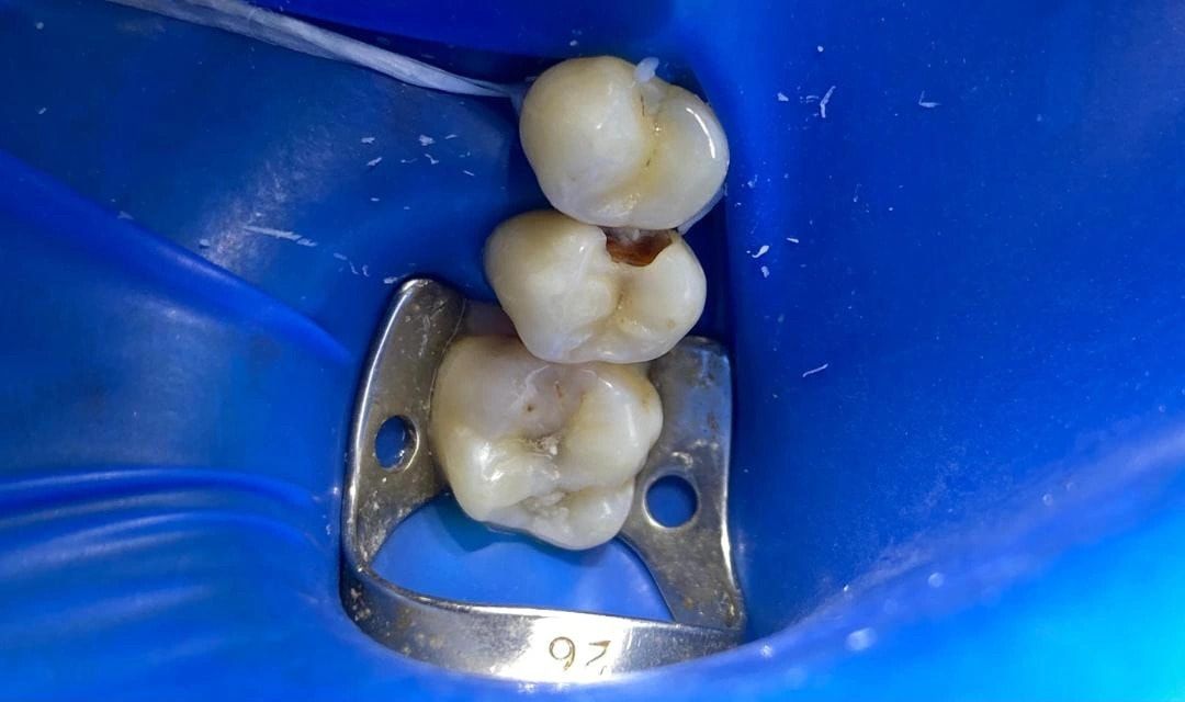 Tedavi öncesinde rubber dam izolasyonu altındaki üst azı dişleri, fissürlerde çürük izleri görülüyor